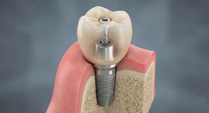 روکش ایمپلنتی اسکرو ریتین چیست؟ راهنمای کامل روکش پیچ شونده روی ایمپلنت