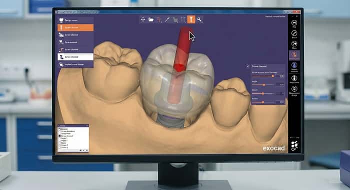  «طراحی دیجیتال روکش ایمپلنتی اسکرو ریتین با سیستم CAD/CAM»