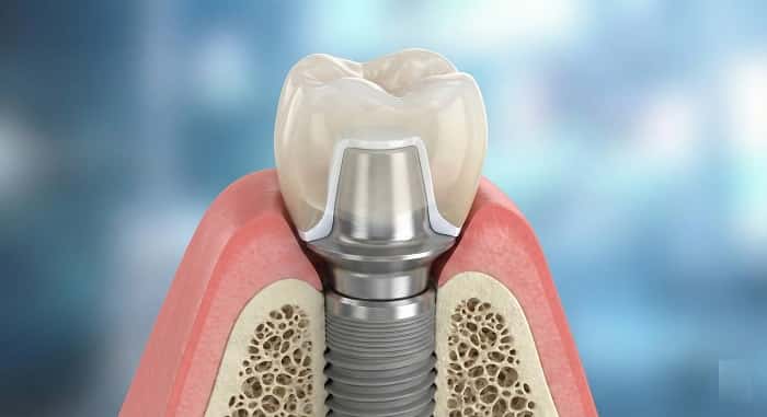 روکش ایمپلنتی سمنت ریتین چیست؟ راهنمای کامل روکش سمان شونده روی ایمپلنت