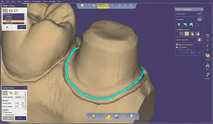 پروتکل طراحی مارژین در پروتز دندانی و طراحی دیجیتال