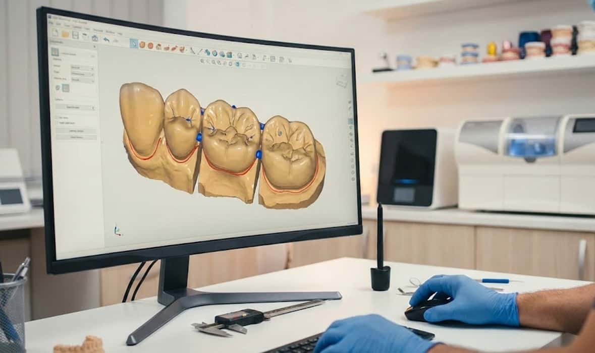 نکات طراحی دیجیتال کرون و بریج در CAD؛ چارچوبی عملی برای لابراتوار و کلینیک