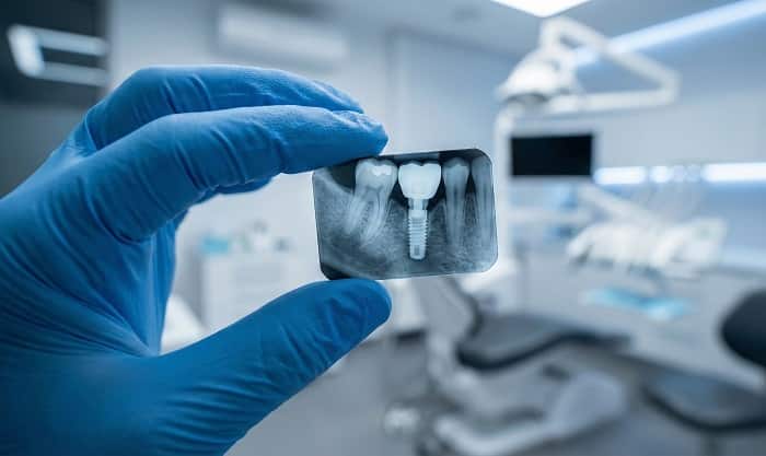 انواع روشهای تصویربرداری برای ایمپلنت