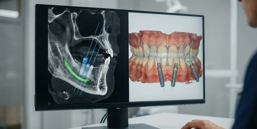 مزایای جراحی گاید شده ایمپلنت