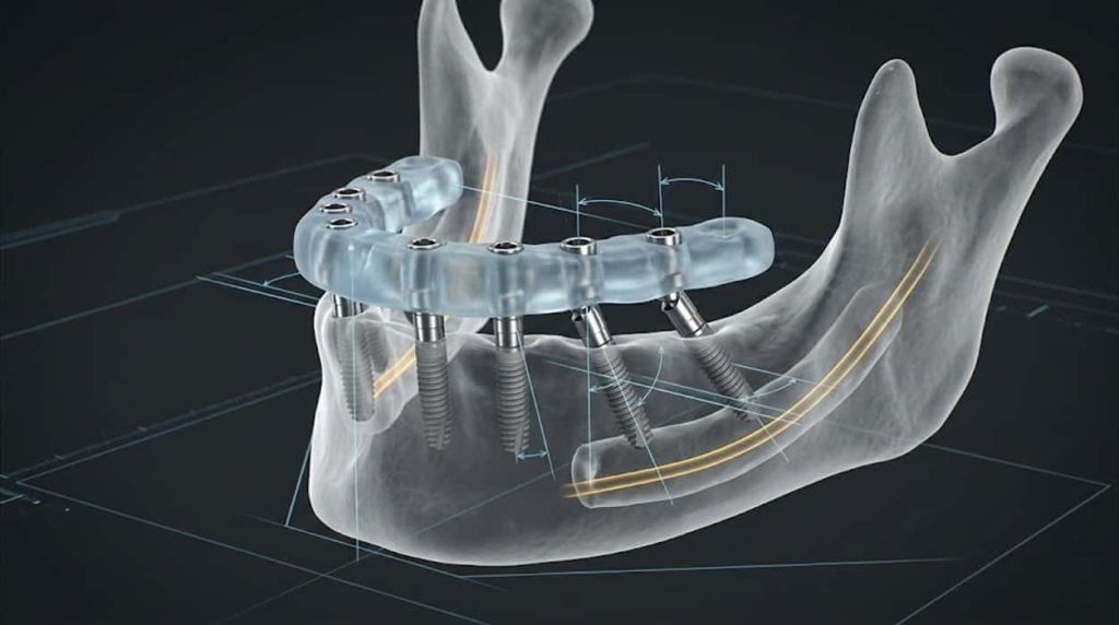 طراحی دیجیتال و گاید جراحی در فک بیدندان