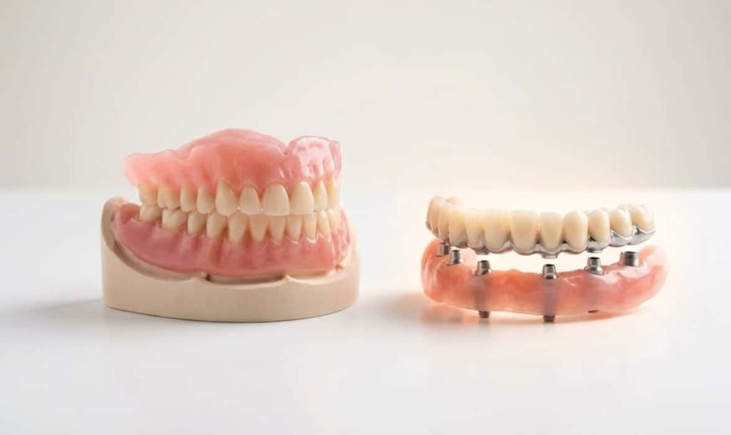 انواع پروتز کامل ثابت روی ایمپلنت