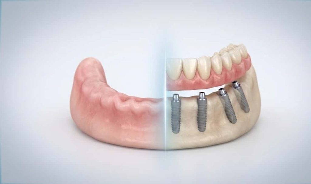 تکنیک All-on-4 در فک بی‌دندان 