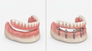ایمپلنت بدون جراحی در فک بی‌دندان