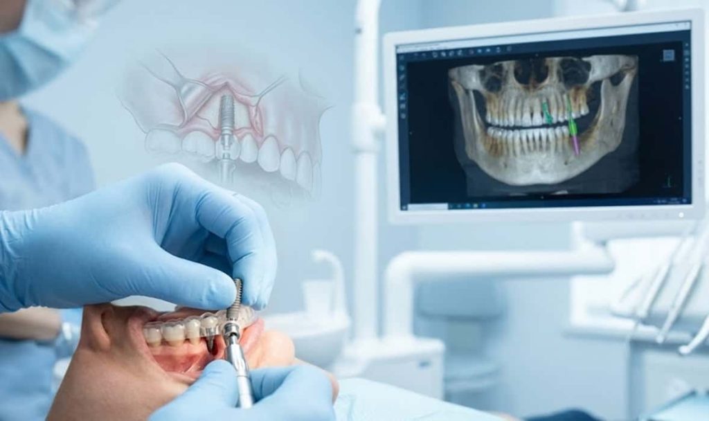 ایمپلنت بدون جراحی